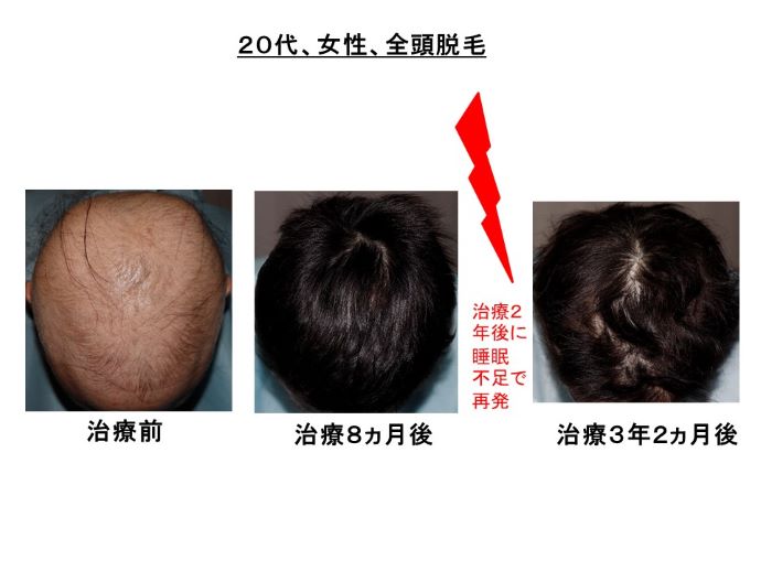 円形脱毛症　病院